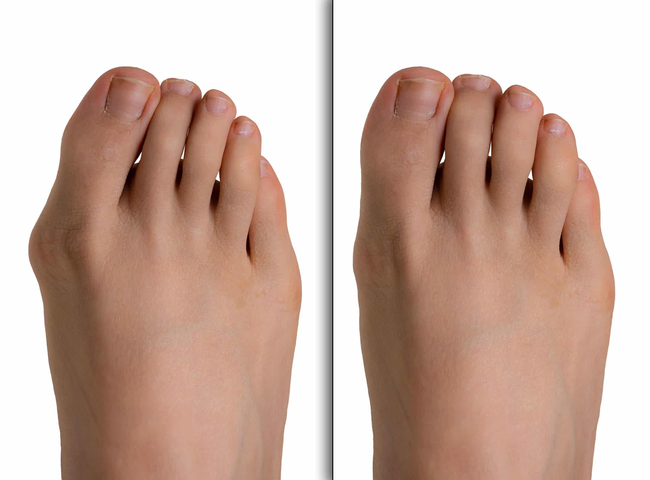 Fußfehlstellung Hallux valgus