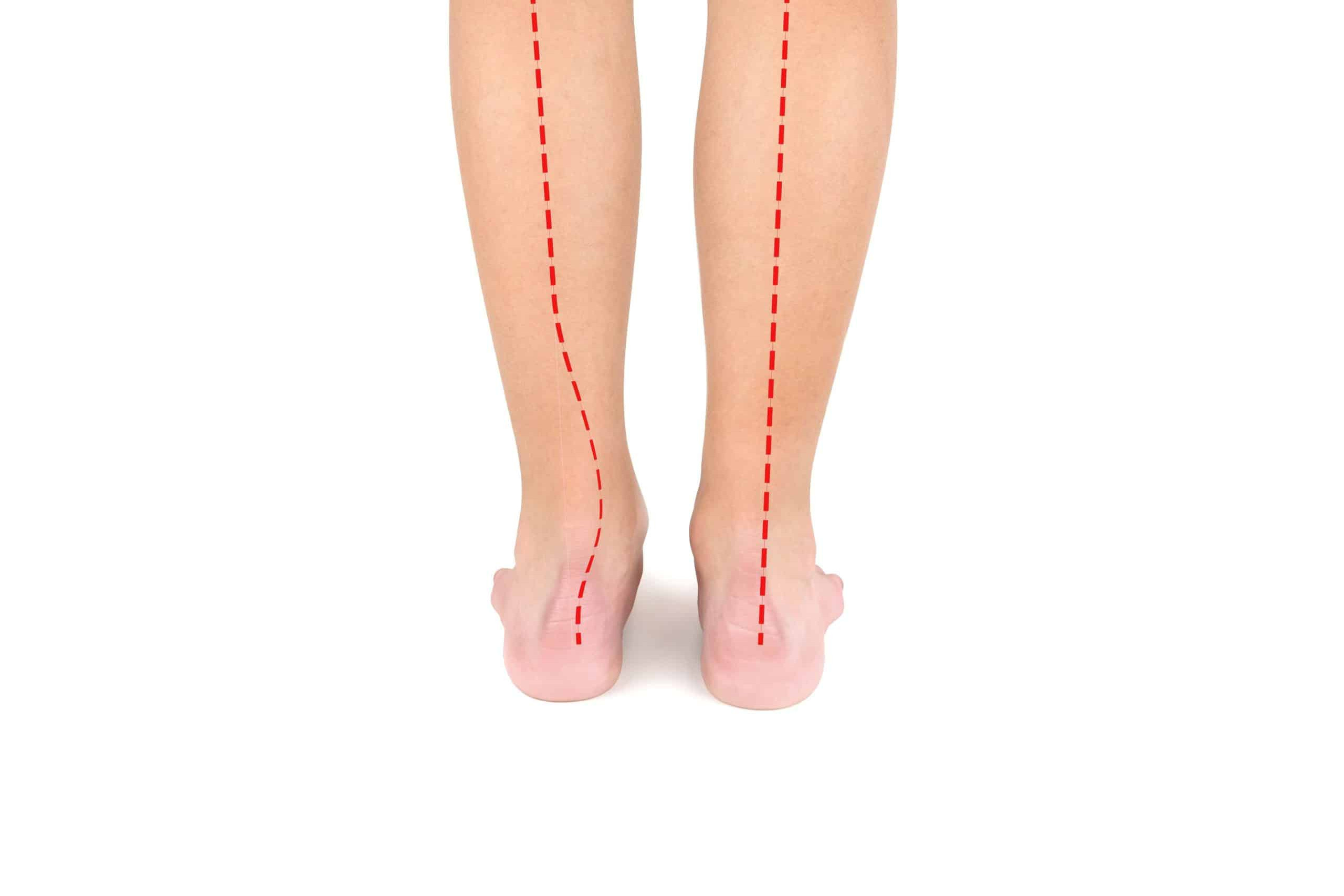 Lower legs, one of which is straight and the other misaligned