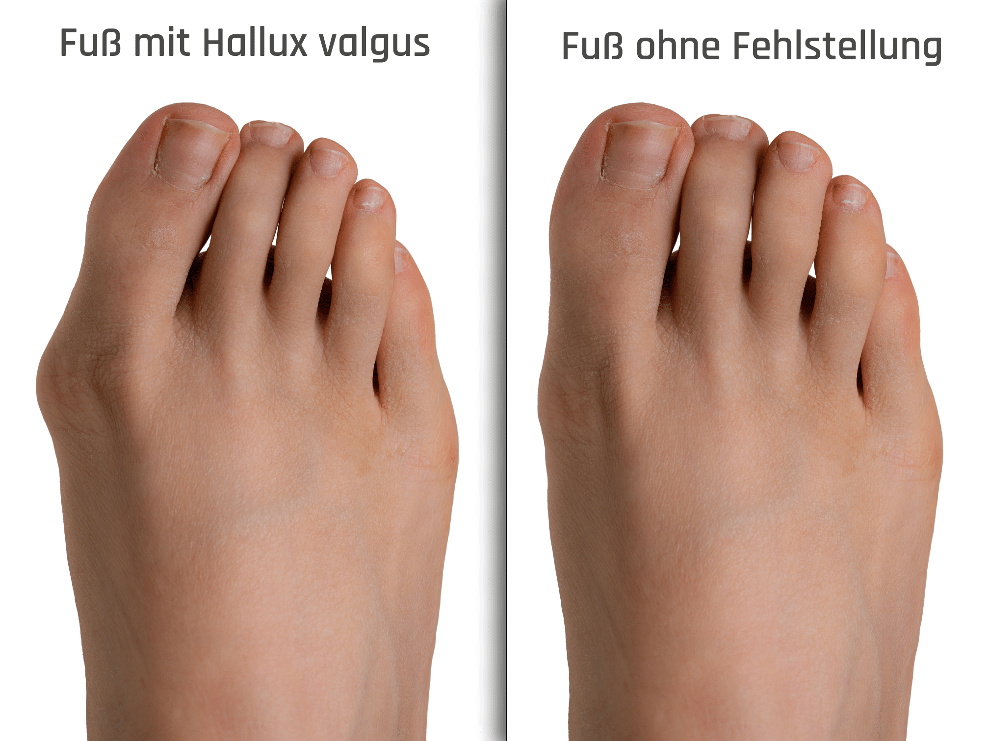 Diagram: Foot with vs. without hallux valgus