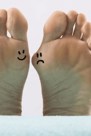 Two soles of the foot, one of which has hallux valgus