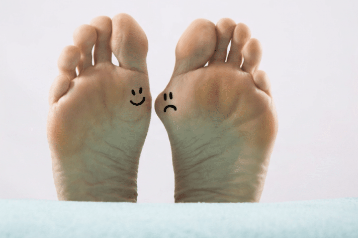 Two soles of the foot, one of which has hallux valgus